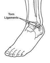 ankle-sprain-peoria-az-foot-doctor